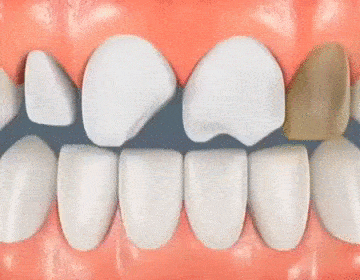 Препарирование зубов под виниры